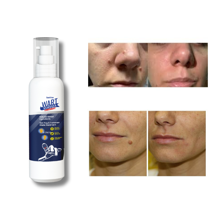 Removedor De Verrugas Wart Remover