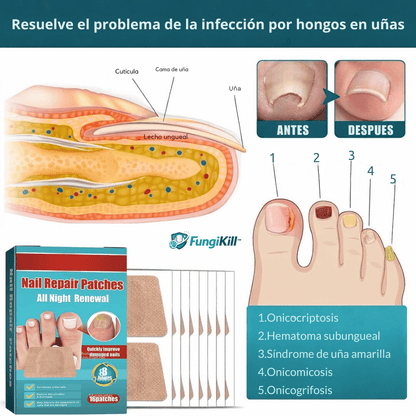FungiKill™ Parche Elimina Hongos en Uñas, Protege y Restaura Pack x36 Parches