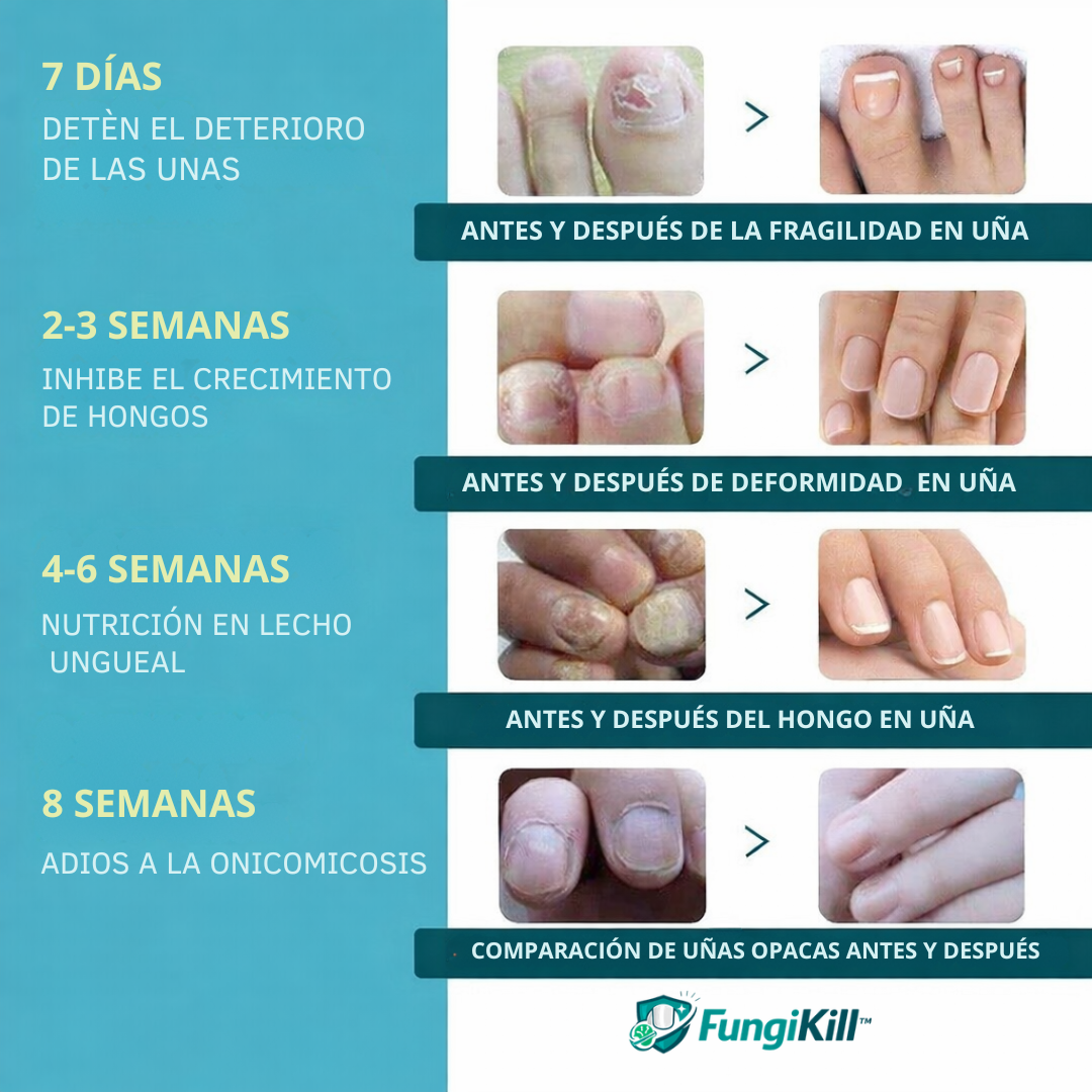 FungiKill™ Parche Elimina Hongos en Uñas, Protege y Restaura Pack x36 Parches